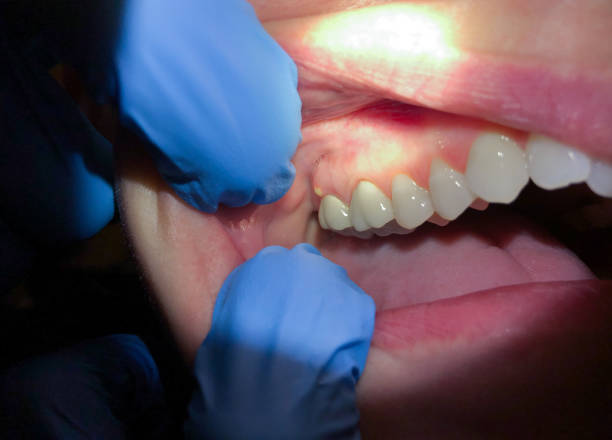 Best Emergency Dentist for Lost Fillings or Crowns in Heyworth, IL